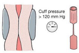 Cuff pressure above systolic: no blood flow