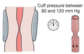 Cuff pressure between systolic and diastolic: turbulent flow and sound