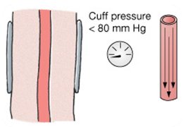 Cuff pressure below diastolic: silent, normal flow