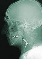 MRI image of a human head