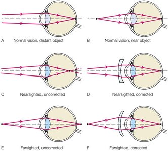 Diagrams of normal, nearsighted, and farsighted vision with corrections