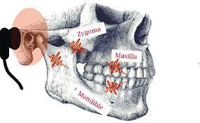 Teeth vibration, an example of local vibration