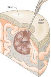 Ultrasonic probe shattering tumor