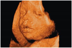 3D ultrasound image of a fetus