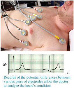 Electrocardiogram electrodes and signal