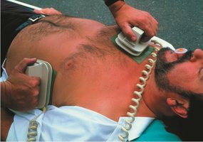 Medical use of a capacitor: defibrillator