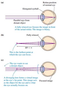 Myopia correction with diverging lens