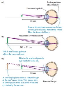 Hyperopia correction with converging lens