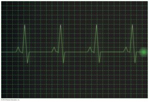Electrocardiogram showing periodic motion