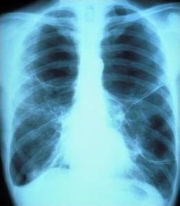 X-ray image of a chest