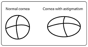 Normal cornea vs cornea with astigmatism