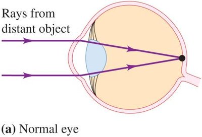 Normal eye focusing rays from a distant object on the retina