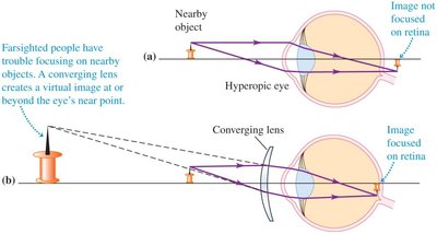 Correction of hyperopia with a converging lens