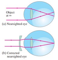 Corrective lenses for myopia and hyperopia