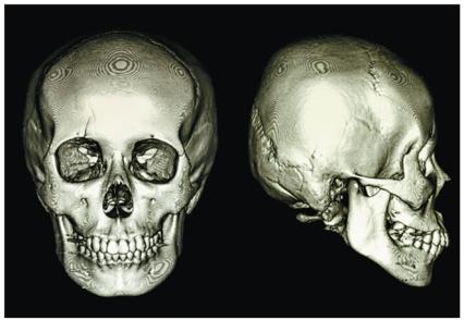 3D reconstruction of a skull from CT data