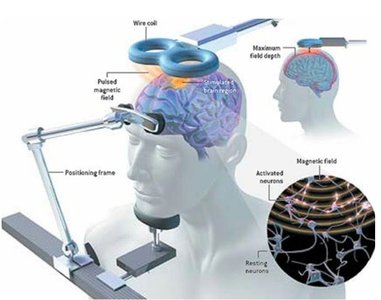 Diagram of Transcranial Magnetic Stimulation (TMS) showing magnetic field interaction with the brain
