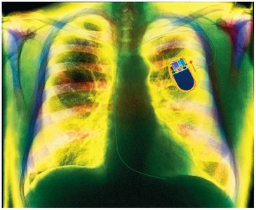 X-ray image showing a heart pacemaker