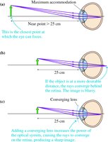 Hyperopia correction with converging lens