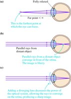 Myopia correction with diverging lens