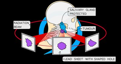 Gamma radiation beams targeting a tumour in radiotherapy