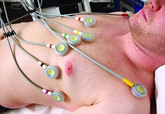 Electrocardiogram electrodes on a patient