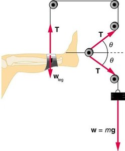 Traction system for a fractured leg, showing tension and weight forces
