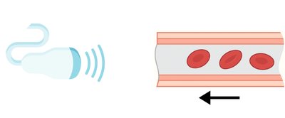 Doppler ultrasound measuring blood flow
