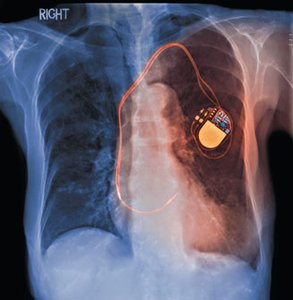 X-ray of chest with pacemaker