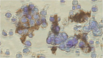 Microscope image of cancer cells with ferromagnetic nanoparticles
