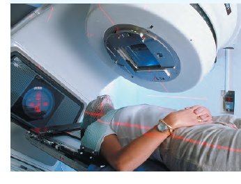 Cancer radiotherapy treatment