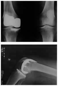 X-ray of knee joint replacement