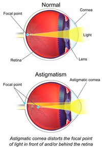 Diagram of normal eye and astigmatism