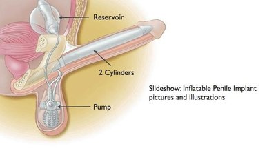 Diagram of inflatable penile implant showing reservoir, cylinders, and pump