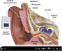 Cochlear implant