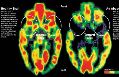 PET scans comparing healthy and abused infant brains