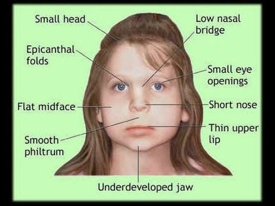 Physical features of fetal alcohol syndrome