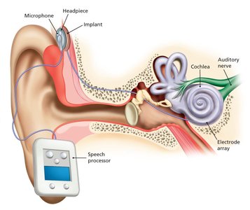 Cochlear Implant