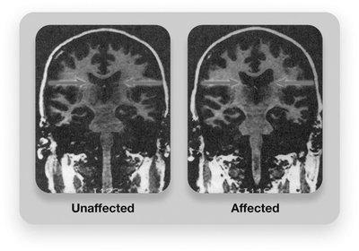 Headline about cannabis-induced psychosis risk