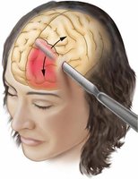 Illustration of prefrontal lobotomy procedure