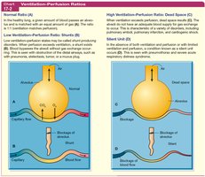 Diagram of ventilation-perfusion ratios: normal, shunt, dead space, and silent unit.