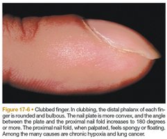 Photograph of a clubbed finger, showing rounded and bulbous distal phalanx.