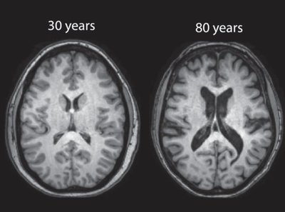 MRI scans of brains at 30 and 80 years showing age-related atrophy