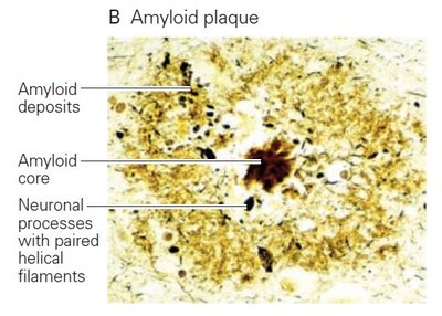 Amyloid plaque in Alzheimer's disease brain tissue