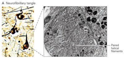 Neurofibrillary tangle in Alzheimer's disease brain tissue