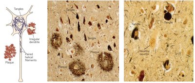 Diagram and micrographs of tangles and plaques in Alzheimer's disease