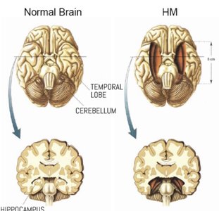 Normal brain vs. HM brain (amnesia)