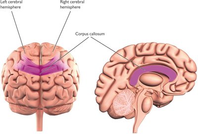 Diagram of cerebral hemispheres and corpus callosum