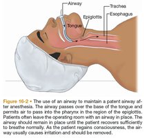Diagram of airway management with labeled anatomy