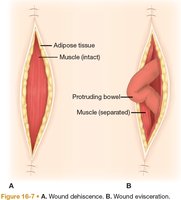 Diagram of wound dehiscence and evisceration