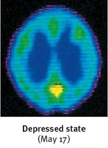Brain scan: Depressed state (May 17)